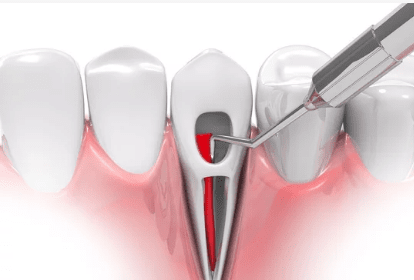 Single sitting Root Canal treatment in Jalandhar