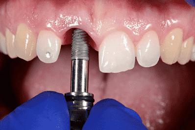 Single tooth implants service