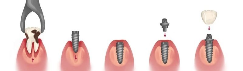 dental-implant-procedure-step-by-step
