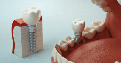 dental-implant-treatment