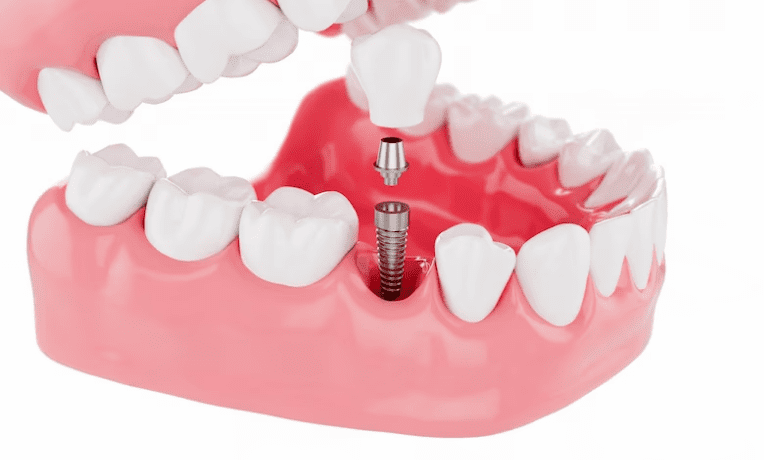 What to know before getting Dental Implants