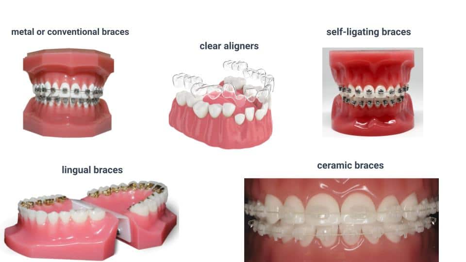 Types of Braces in Orthodontic Treatment