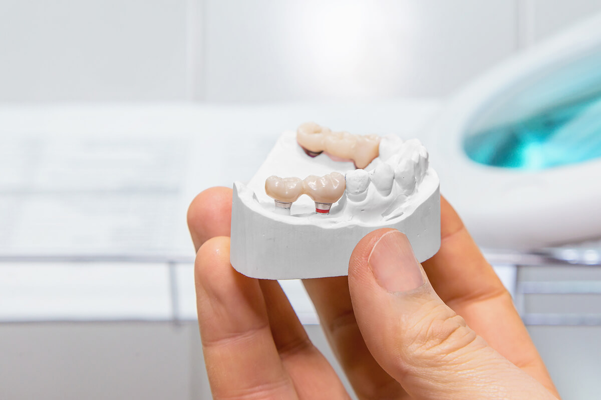 Understanding the Process and Feasibility of Removing and Recementing Dental Bridges