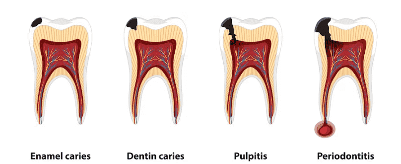 dental-caries-types